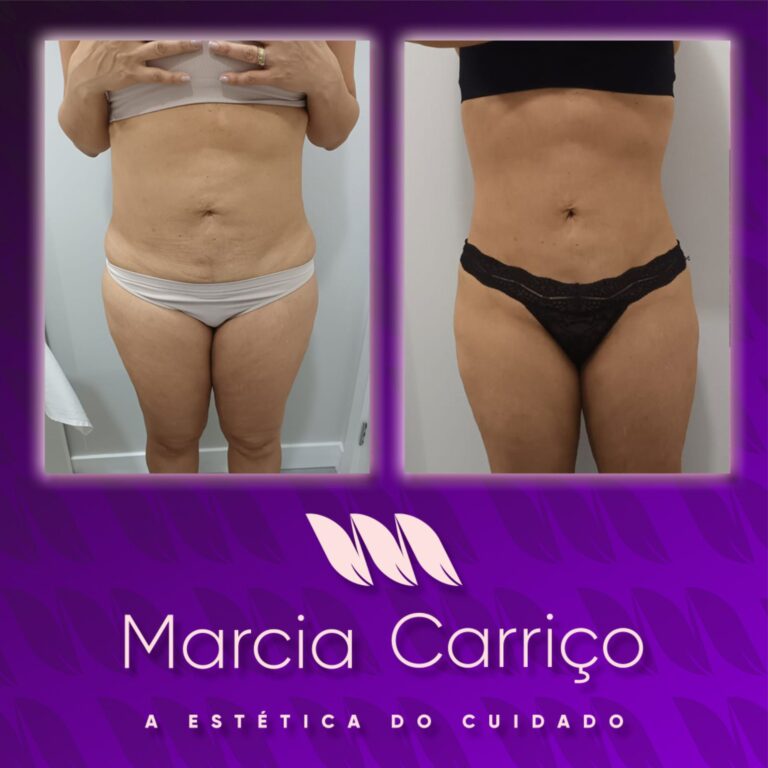 Márcia Carrico foi pioneira em trazer Tração Cíclica nos procedimentos