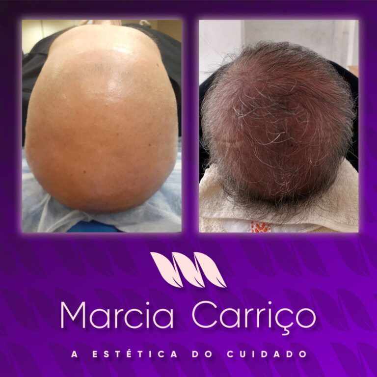 Inovação – Tratamento capilar com Tração Cíclica na Clínica Márcia Carriço
