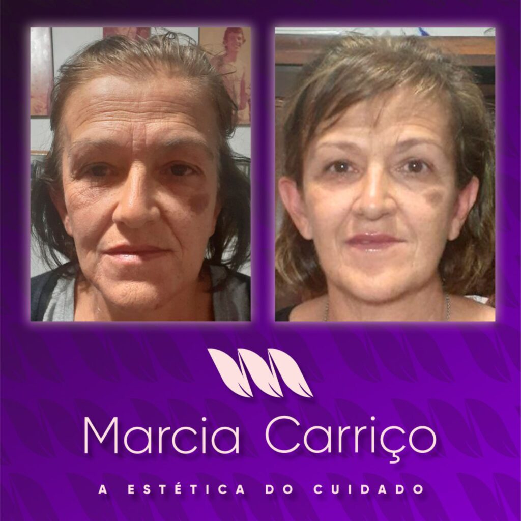 Tratamento de Rejuvenescimento na Clínica Márcia Carriço
